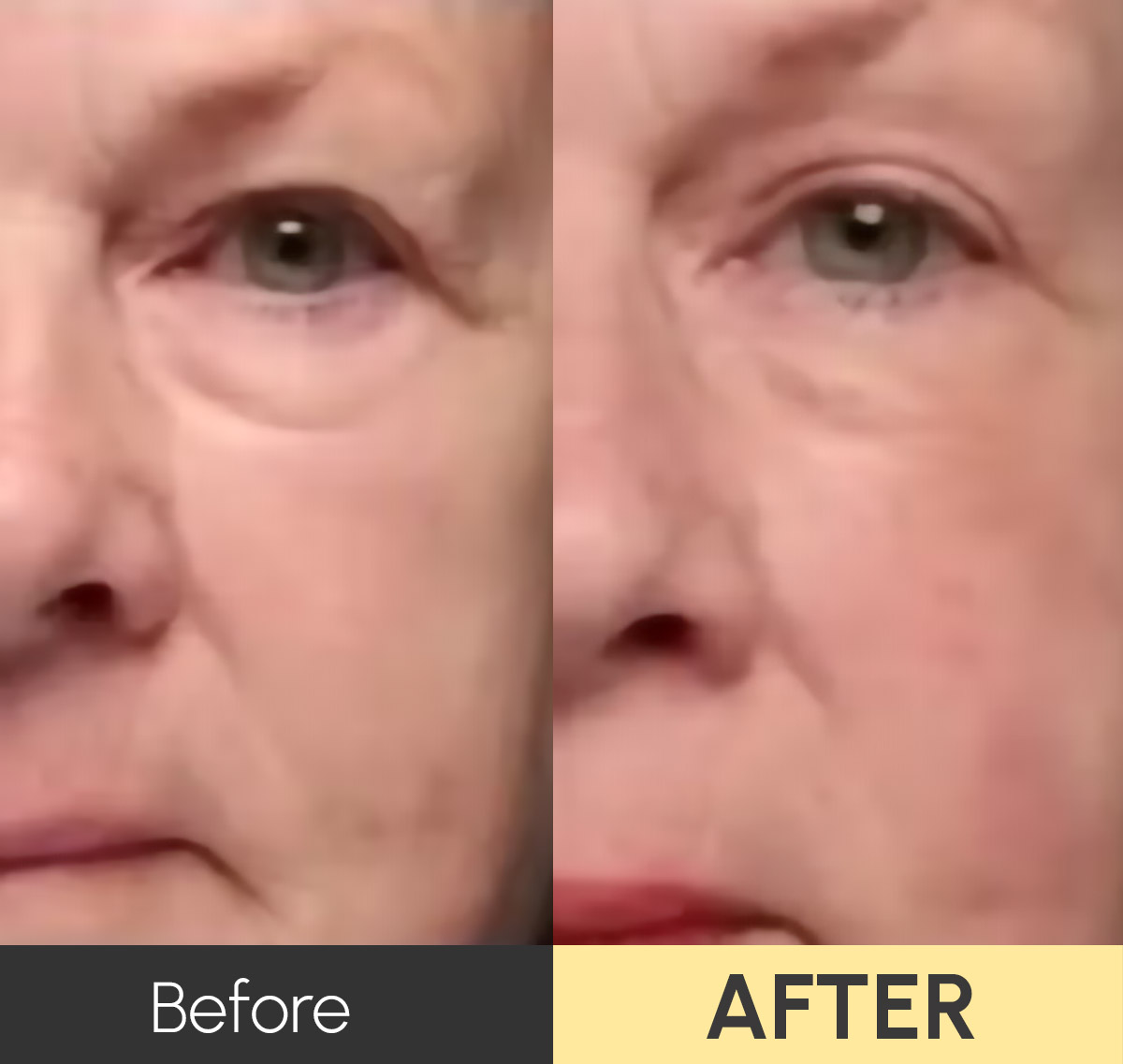 Morpheus 8 Treatment Results in Tuscola and Abilene, TX_1