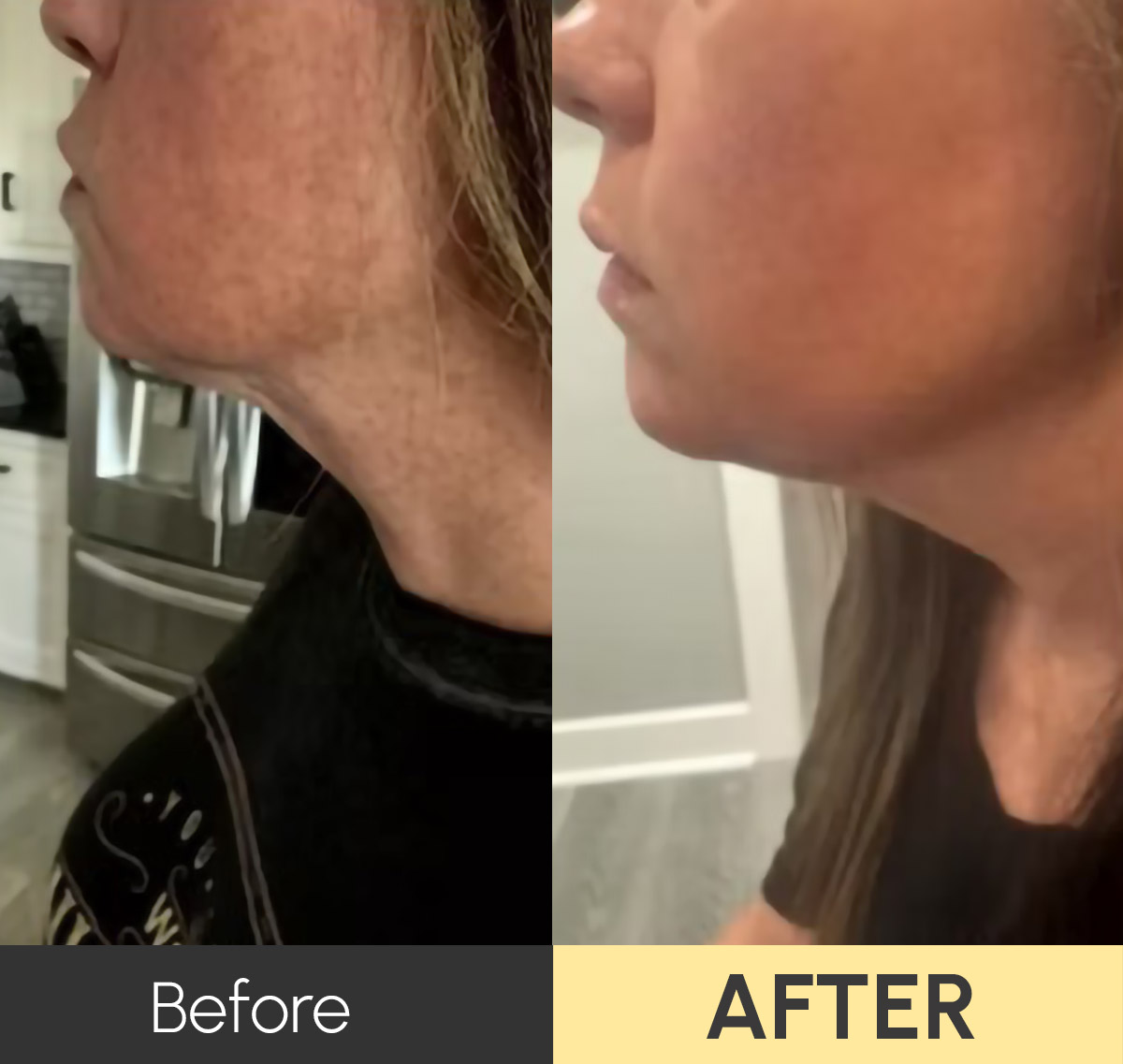Morpheus 8 Treatment Results in Tuscola and Abilene, TX_2
