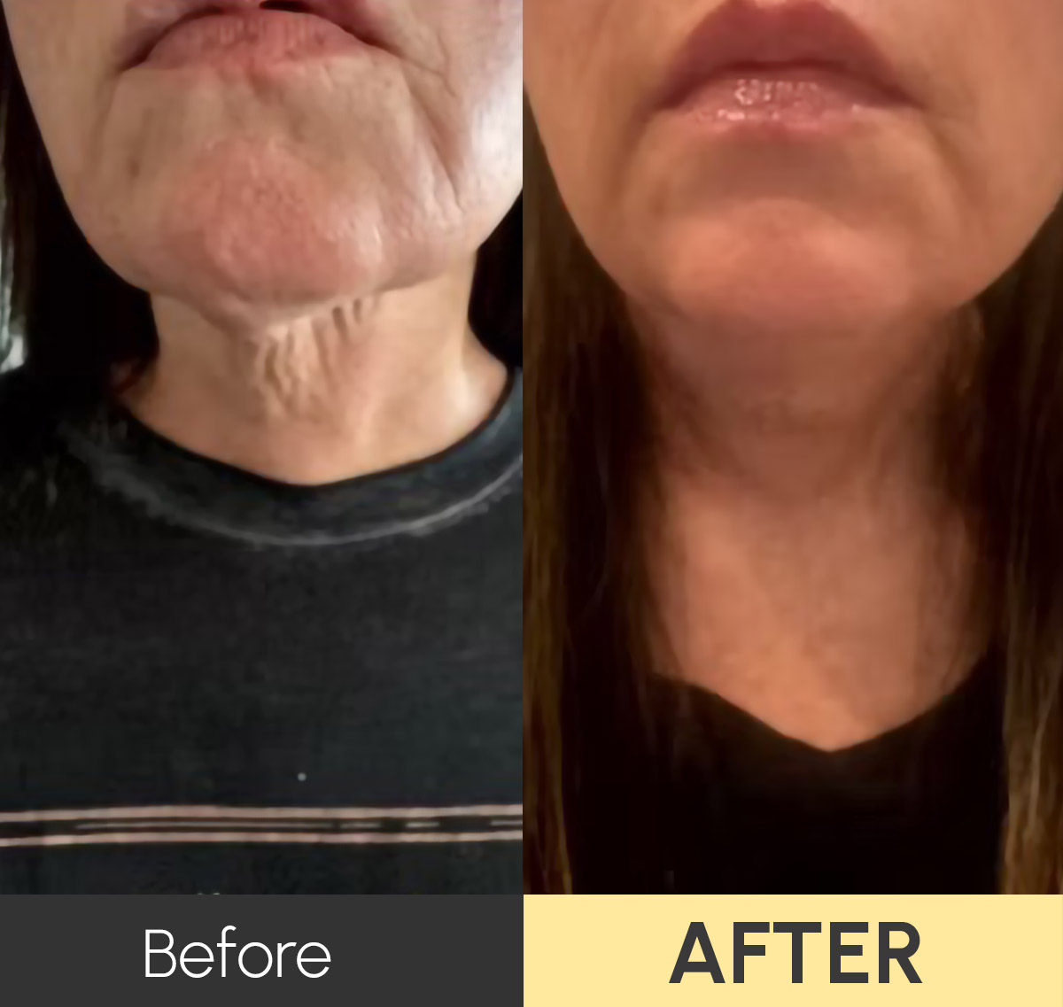Morpheus 8 Treatment Results in Tuscola and Abilene, TX_3