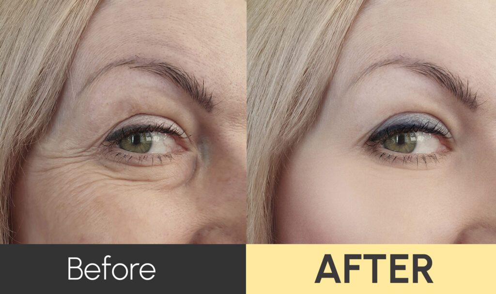 Potential resutls of Botox treatment in Abilene and Tuscola, TX