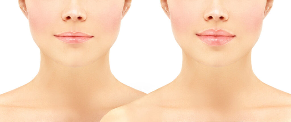 Lip fillers in Tuscola and Abilene, TX